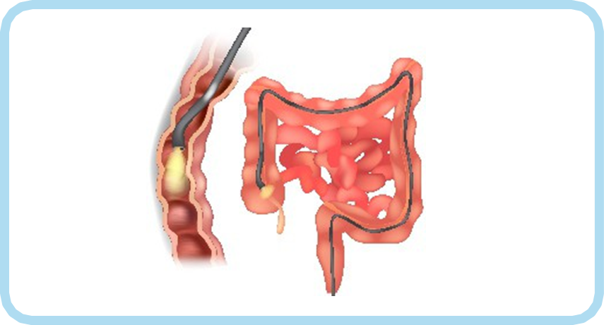 ALIMENTE ȘI BĂUTURI INTERZISE CU 3 ZILE ÎNAINTE DE COLONOSCOPIE